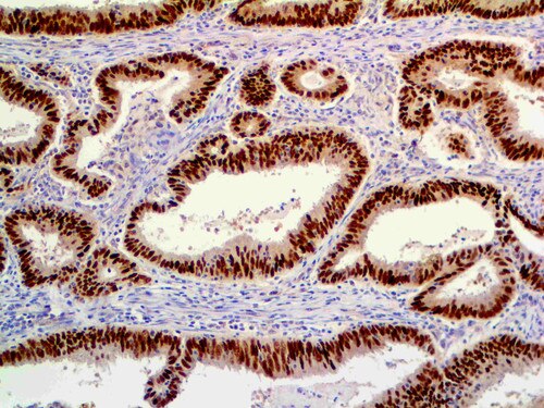 IHC of CDK4 on an FFPE Colon Carcinoma Tissue